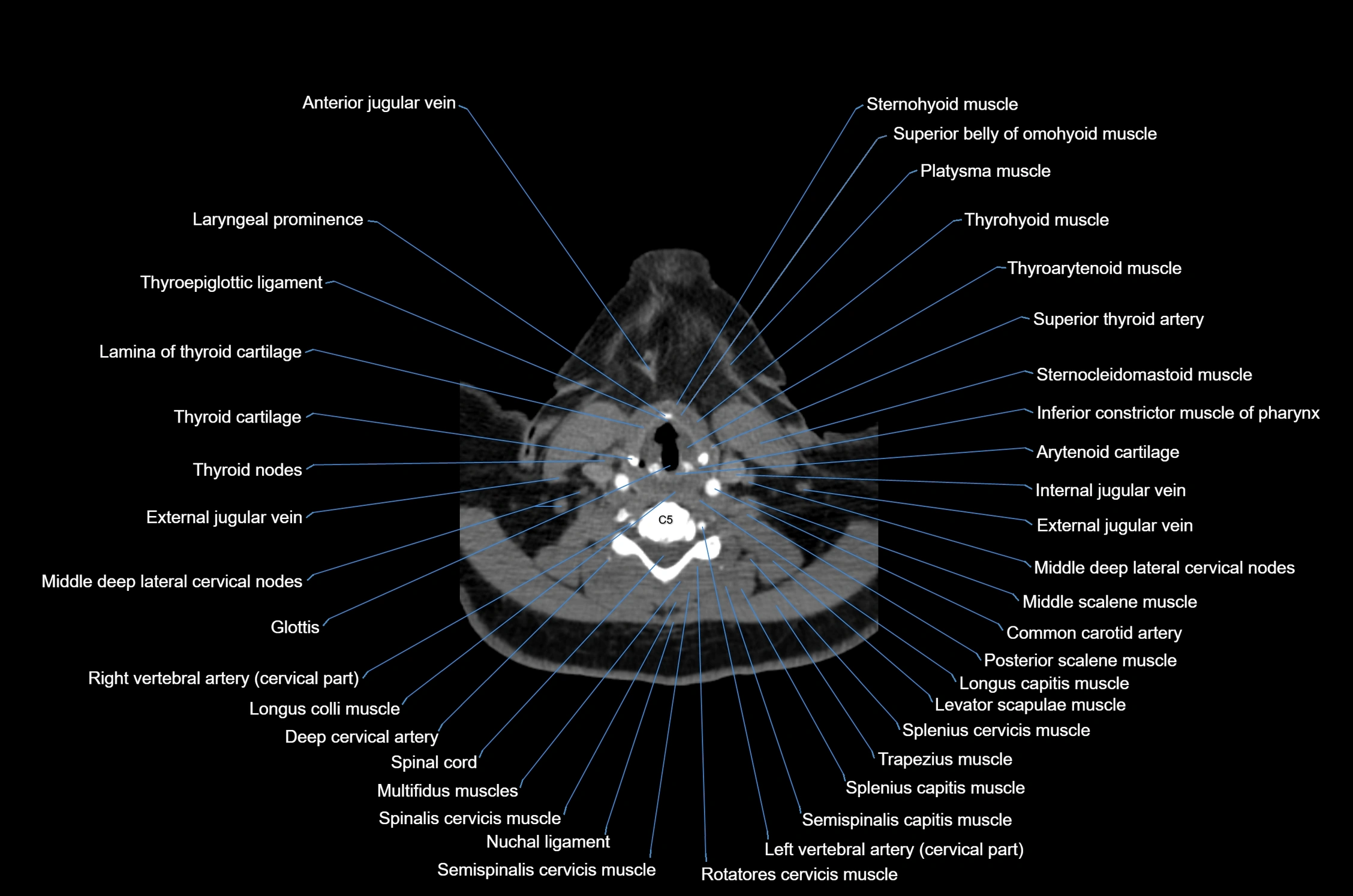 CT Neck axial cross sectional anatomy radiology image-img-00001-00042.webp